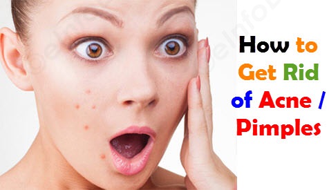 get rid of acne naturally